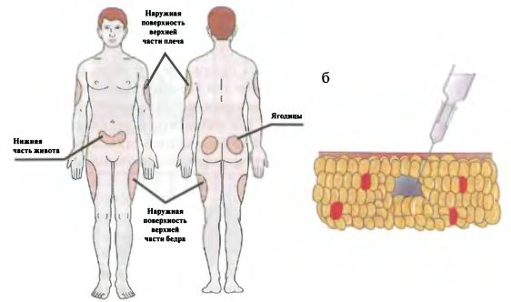 як правильно вводити інсулін